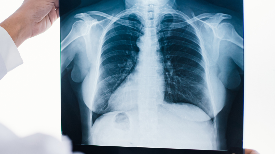 Two employees at Newmont's Cadia gold mine have been diagnosed with silicosis